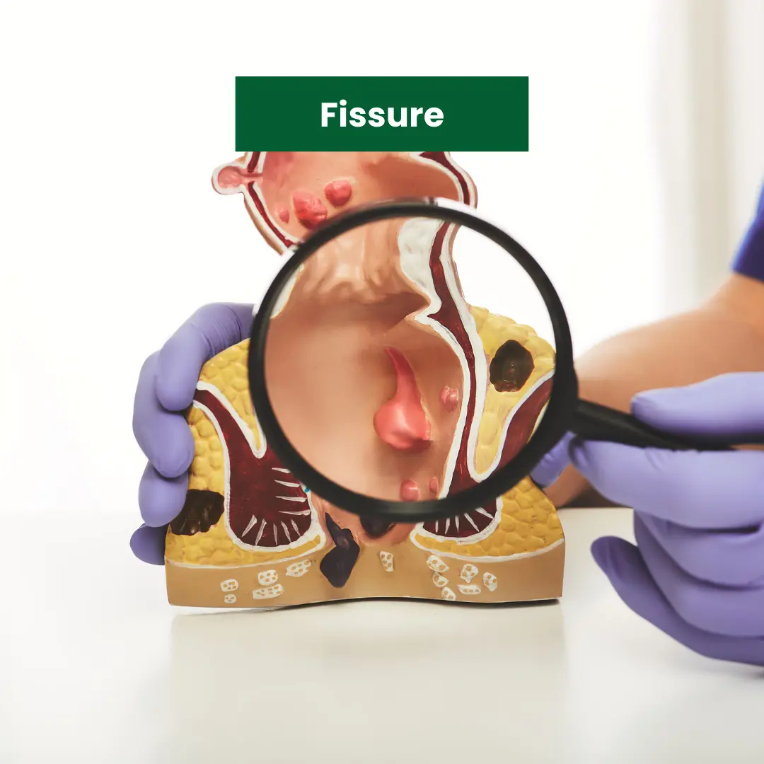 Fissure-Ayurveda-Treatment