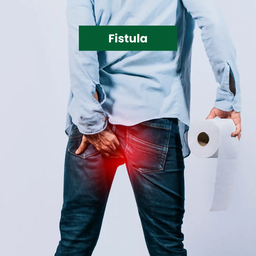 Fistula-Treatment